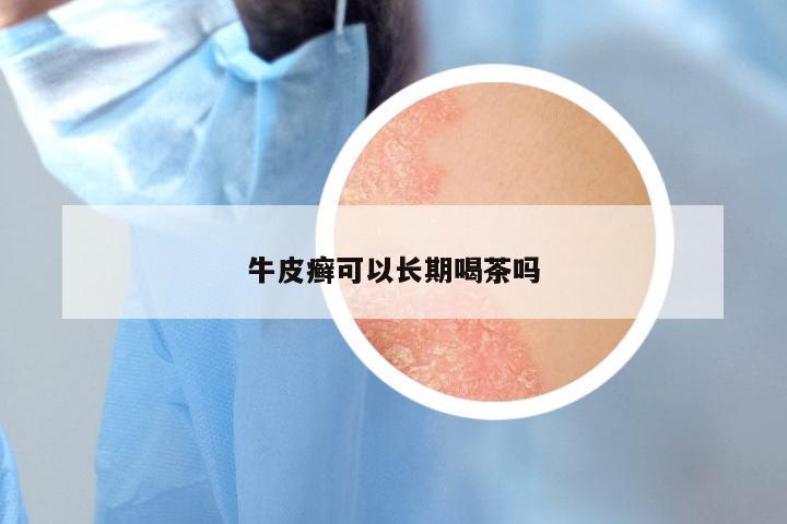 牛皮癣可以长期喝茶吗
