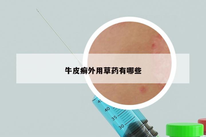 牛皮癣外用草药有哪些