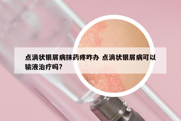 点滴状银屑病抹药疼咋办 点滴状银屑病可以输液治疗吗?
