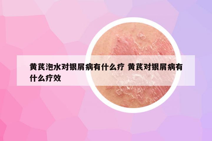 黄芪泡水对银屑病有什么疗 黄芪对银屑病有什么疗效