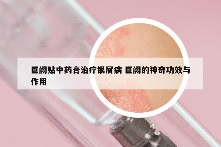 巨阙贴中药膏治疗银屑病 巨阙的神奇功效与作用