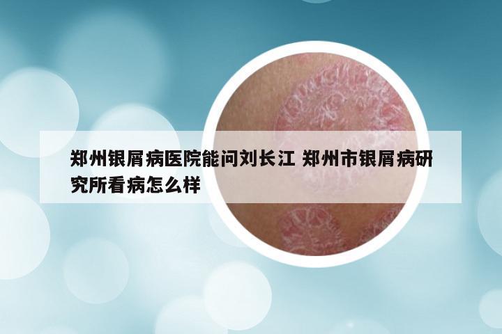 郑州银屑病医院能问刘长江 郑州市银屑病研究所看病怎么样