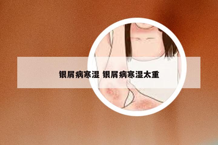 银屑病寒湿 银屑病寒湿太重