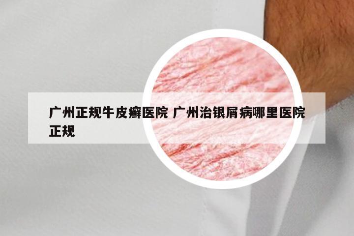 广州正规牛皮癣医院 广州治银屑病哪里医院正规