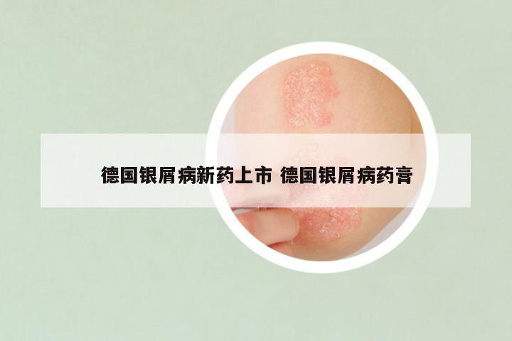 德国银屑病新药上市 德国银屑病药膏