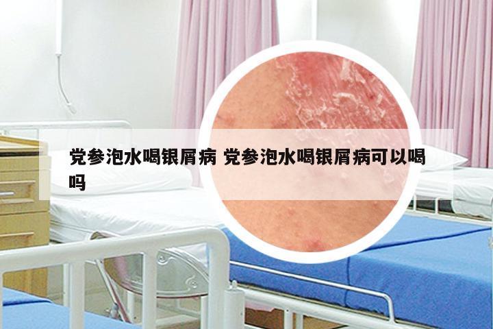 党参泡水喝银屑病 党参泡水喝银屑病可以喝吗