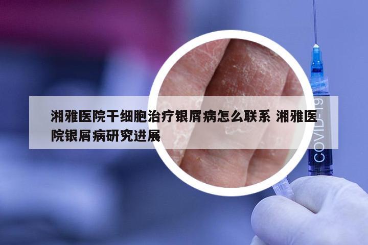 湘雅医院干细胞治疗银屑病怎么联系 湘雅医院银屑病研究进展