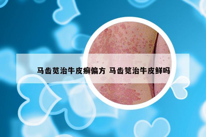 马齿苋治牛皮癣偏方 马齿笕治牛皮鲜吗