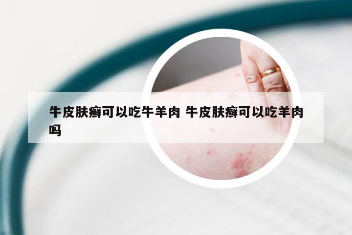 牛皮肤癣可以吃牛羊肉 牛皮肤癣可以吃羊肉吗