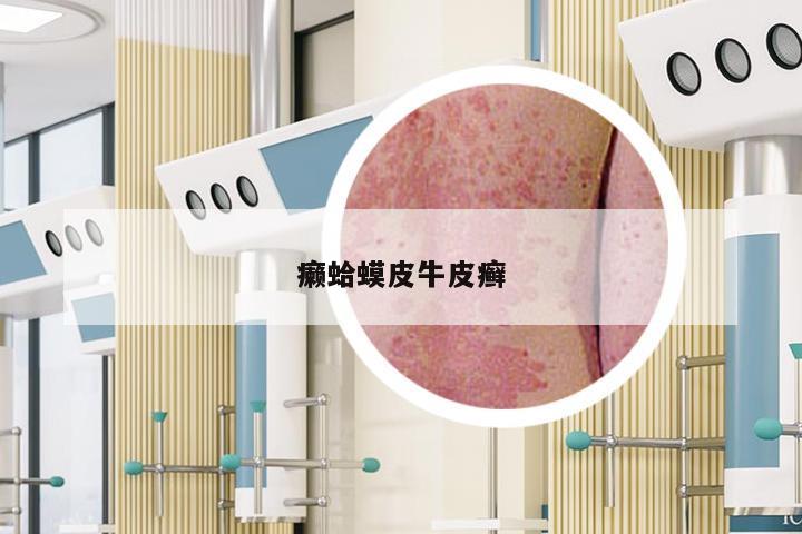 癞蛤蟆皮牛皮癣