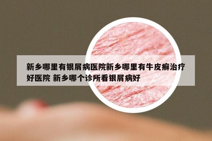 新乡哪里有银屑病医院新乡哪里有牛皮癣治疗好医院 新乡哪个诊所看银屑病好