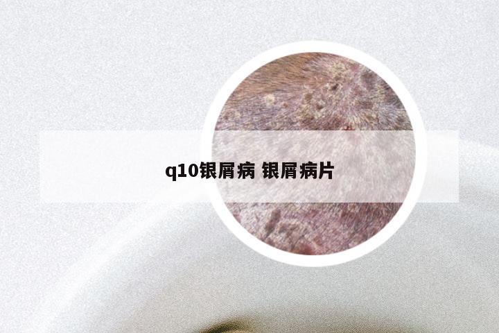 q10银屑病 银屑病片