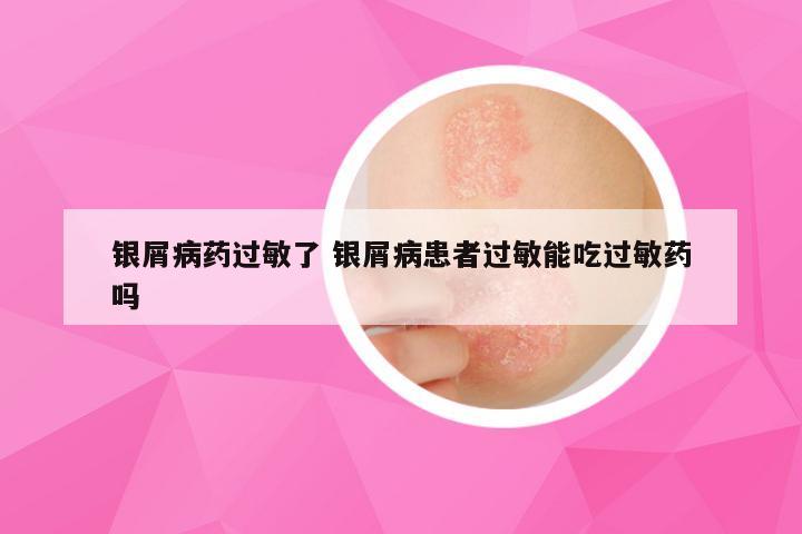 银屑病药过敏了 银屑病患者过敏能吃过敏药吗