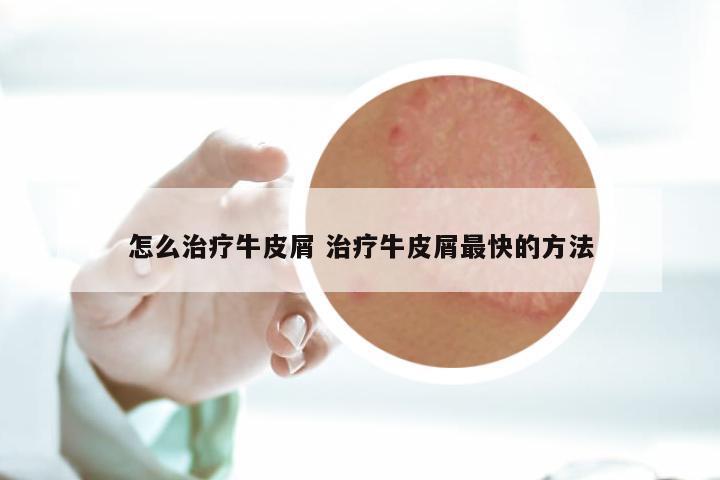 怎么治疗牛皮屑 治疗牛皮屑最快的方法