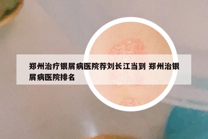 郑州治疗银屑病医院荐刘长江当到 郑州治银屑病医院排名