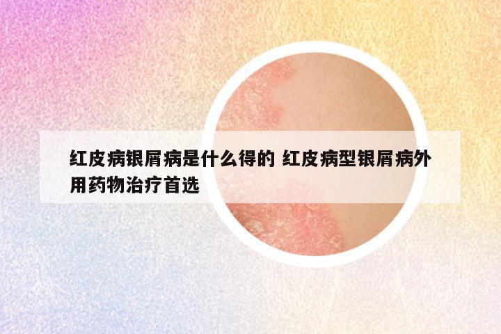 红皮病银屑病是什么得的 红皮病型银屑病外用药物治疗首选 - 东方皮肤网