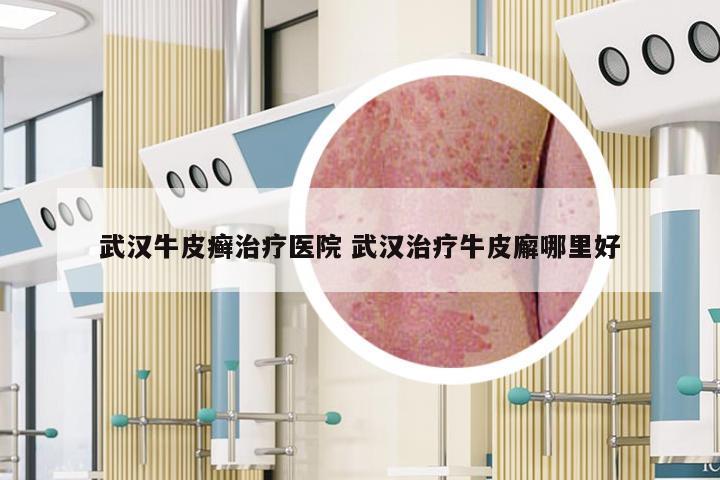 武汉牛皮癣治疗医院 武汉治疗牛皮廨哪里好