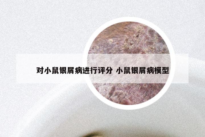 对小鼠银屑病进行评分 小鼠银屑病模型
