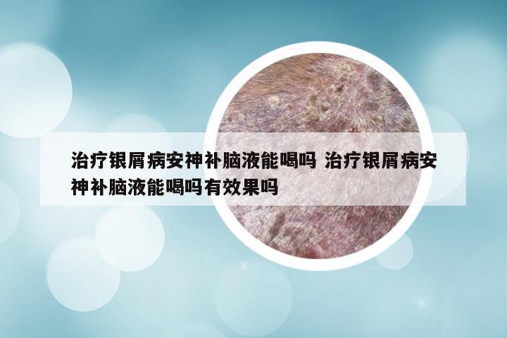 治疗银屑病安神补脑液能喝吗 治疗银屑病安神补脑液能喝吗有效果吗
