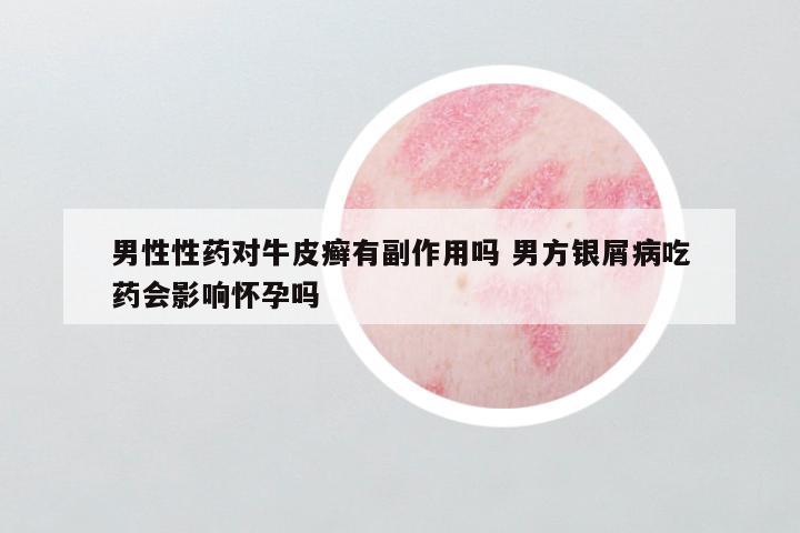 男性性药对牛皮癣有副作用吗 男方银屑病吃药会影响怀孕吗