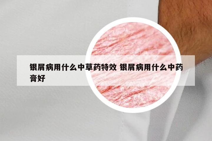 银屑病用什么中草药特效 银屑病用什么中药膏好