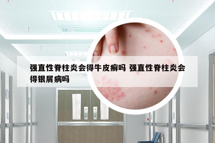 强直性脊柱炎会得牛皮癣吗 强直性脊柱炎会得银屑病吗