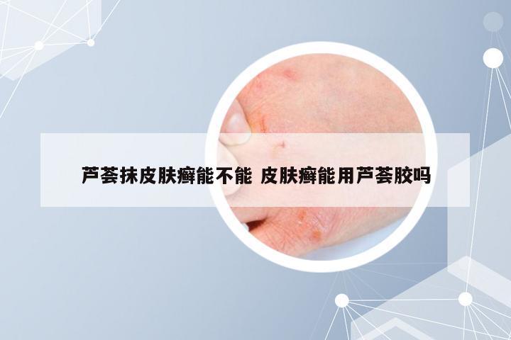 芦荟抹皮肤癣能不能 皮肤癣能用芦荟胶吗