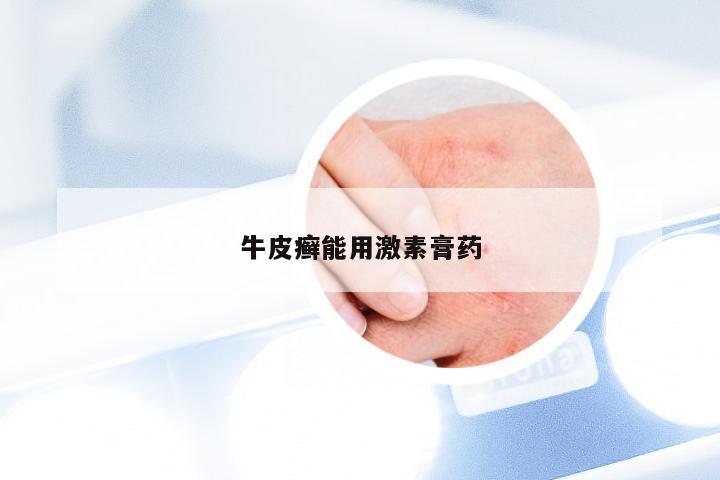 牛皮癣能用激素膏药