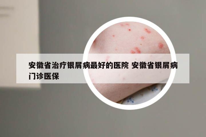 安徽省治疗银屑病最好的医院 安徽省银屑病门诊医保