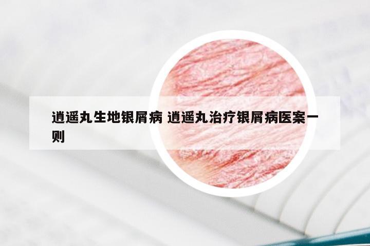 逍遥丸生地银屑病 逍遥丸治疗银屑病医案一则