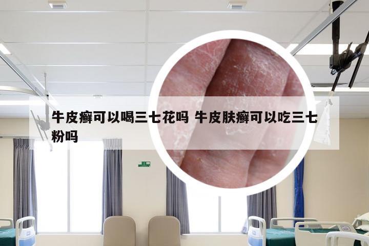 牛皮癣可以喝三七花吗 牛皮肤癣可以吃三七粉吗