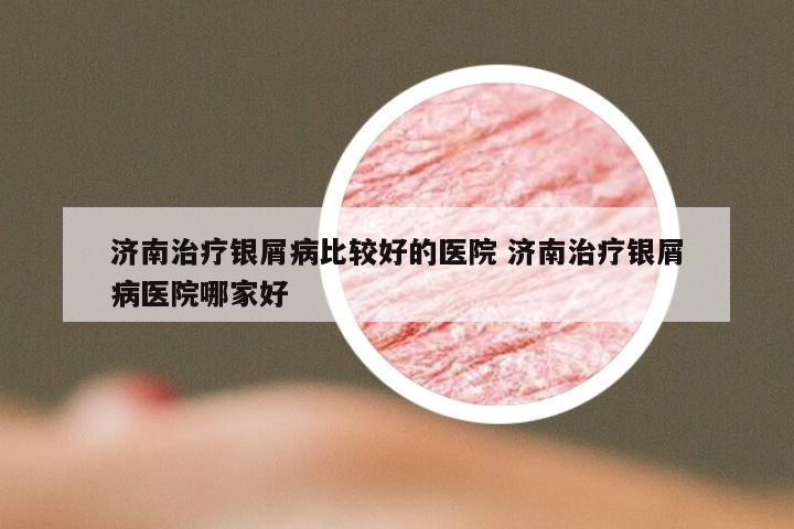 济南治疗银屑病比较好的医院 济南治疗银屑病医院哪家好