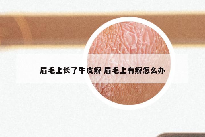 眉毛上长了牛皮癣 眉毛上有癣怎么办