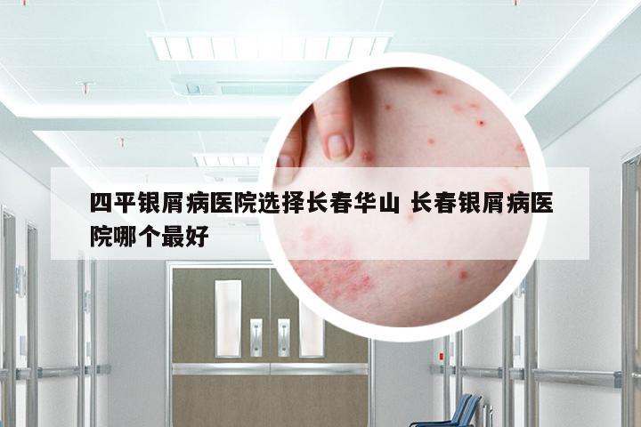 四平银屑病医院选择长春华山 长春银屑病医院哪个最好
