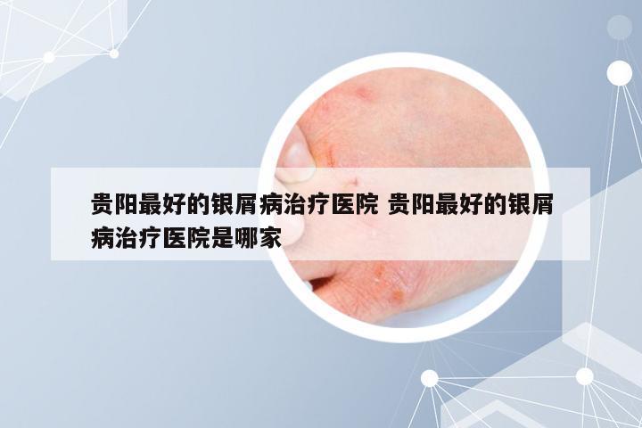 贵阳最好的银屑病治疗医院 贵阳最好的银屑病治疗医院是哪家