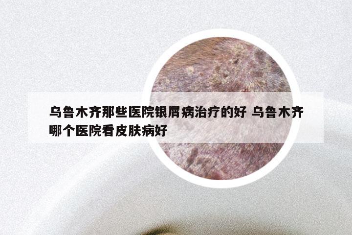 乌鲁木齐那些医院银屑病治疗的好 乌鲁木齐哪个医院看皮肤病好