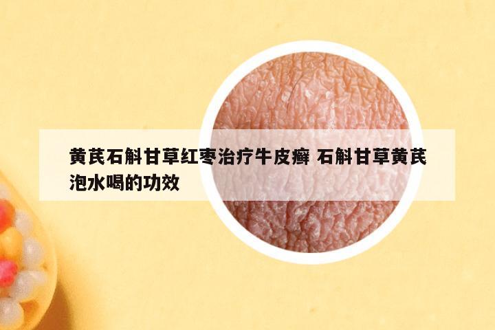 黄芪石斛甘草红枣治疗牛皮癣 石斛甘草黄芪泡水喝的功效