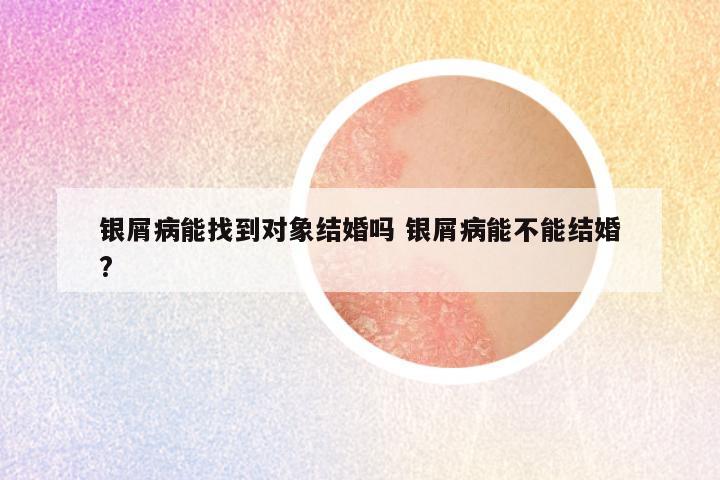 银屑病能找到对象结婚吗 银屑病能不能结婚?