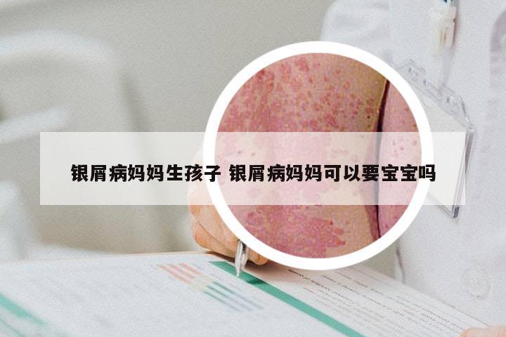 银屑病妈妈生孩子 银屑病妈妈可以要宝宝吗