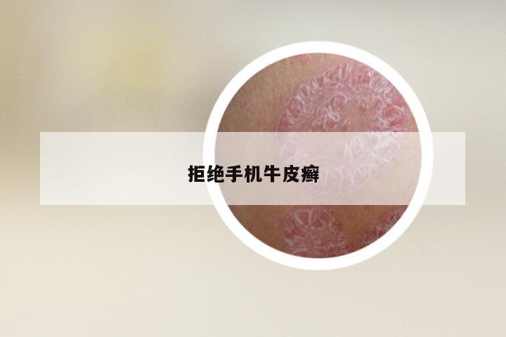 拒绝手机牛皮癣