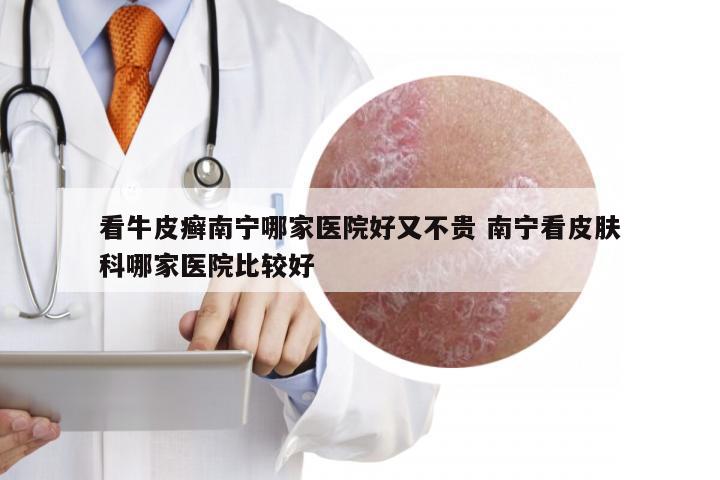 看牛皮癣南宁哪家医院好又不贵 南宁看皮肤科哪家医院比较好
