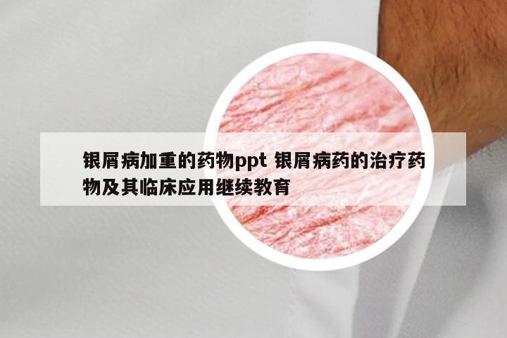 银屑病加重的药物ppt 银屑病药的治疗药物及其临床应用继续教育