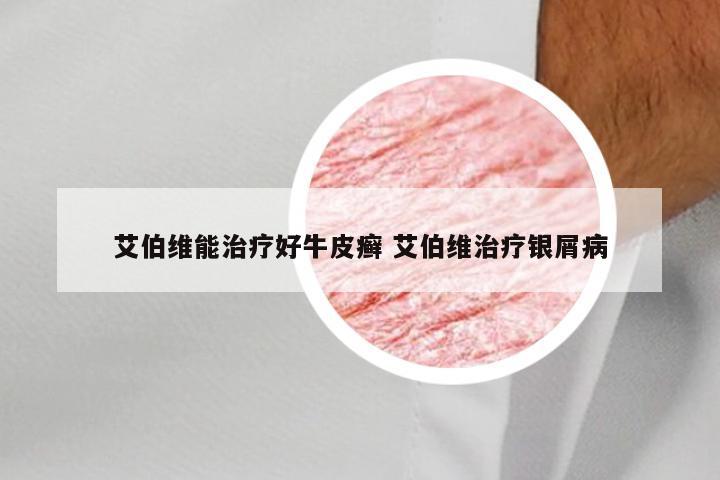 艾伯维能治疗好牛皮癣 艾伯维治疗银屑病