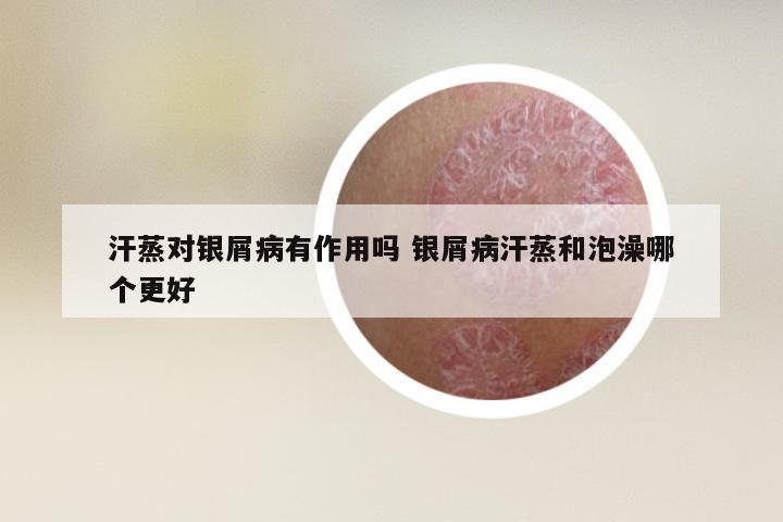 汗蒸对银屑病有作用吗 银屑病汗蒸和泡澡哪个更好
