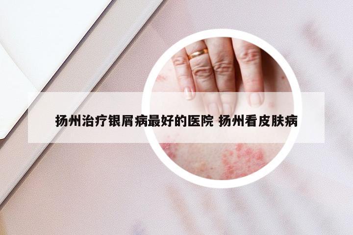 扬州治疗银屑病最好的医院 扬州看皮肤病