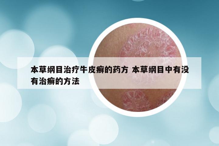 本草纲目治疗牛皮癣的药方 本草纲目中有没有治癣的方法