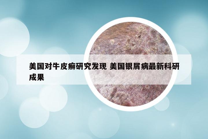 美国对牛皮癣研究发现 美国银屑病最新科研成果