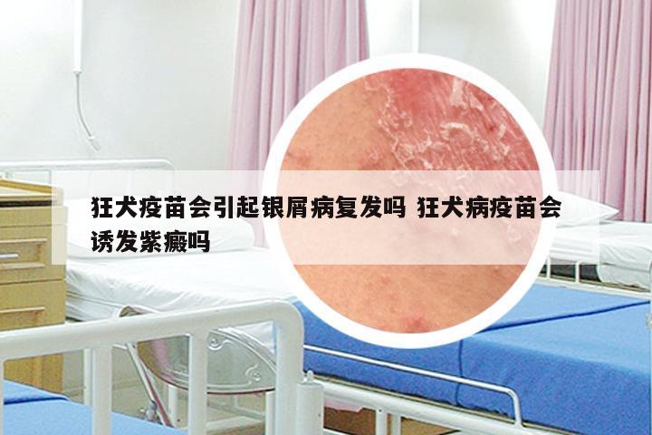 狂犬疫苗会引起银屑病复发吗 狂犬病疫苗会诱发紫癜吗