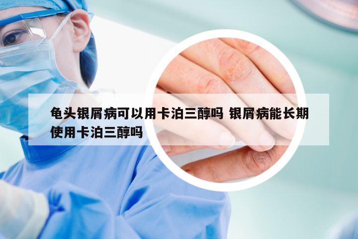 龟头银屑病可以用卡泊三醇吗 银屑病能长期使用卡泊三醇吗