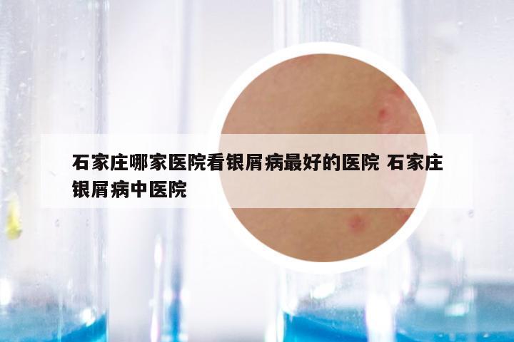 石家庄哪家医院看银屑病最好的医院 石家庄银屑病中医院